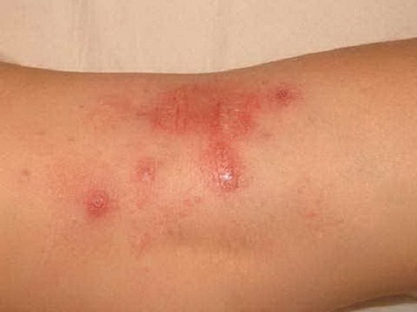 Biểu hiện viêm da tiếp xúc